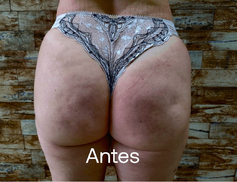 Harmonização Glútea - Antes