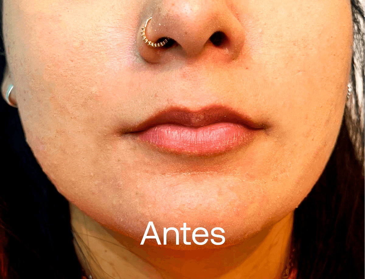 Preenchimento Labial - Antes
