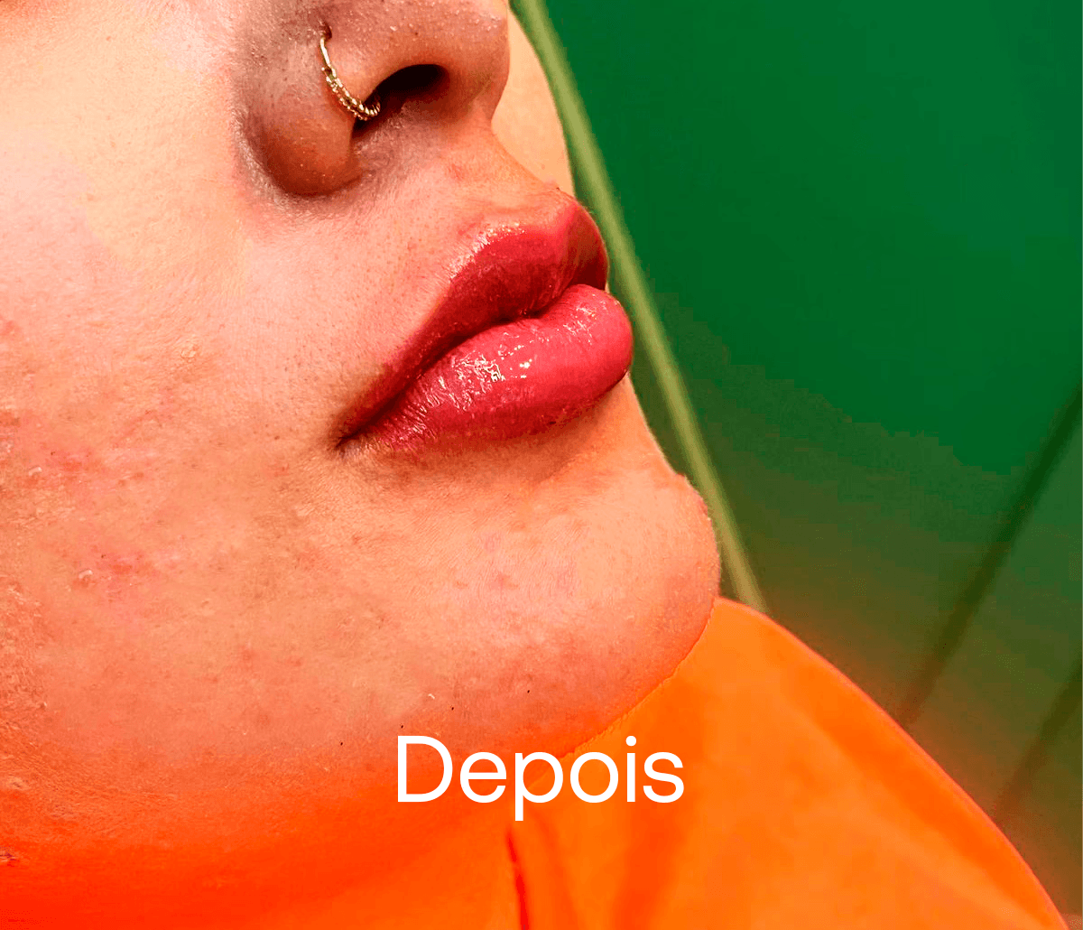 Preenchimento Labial - Depois